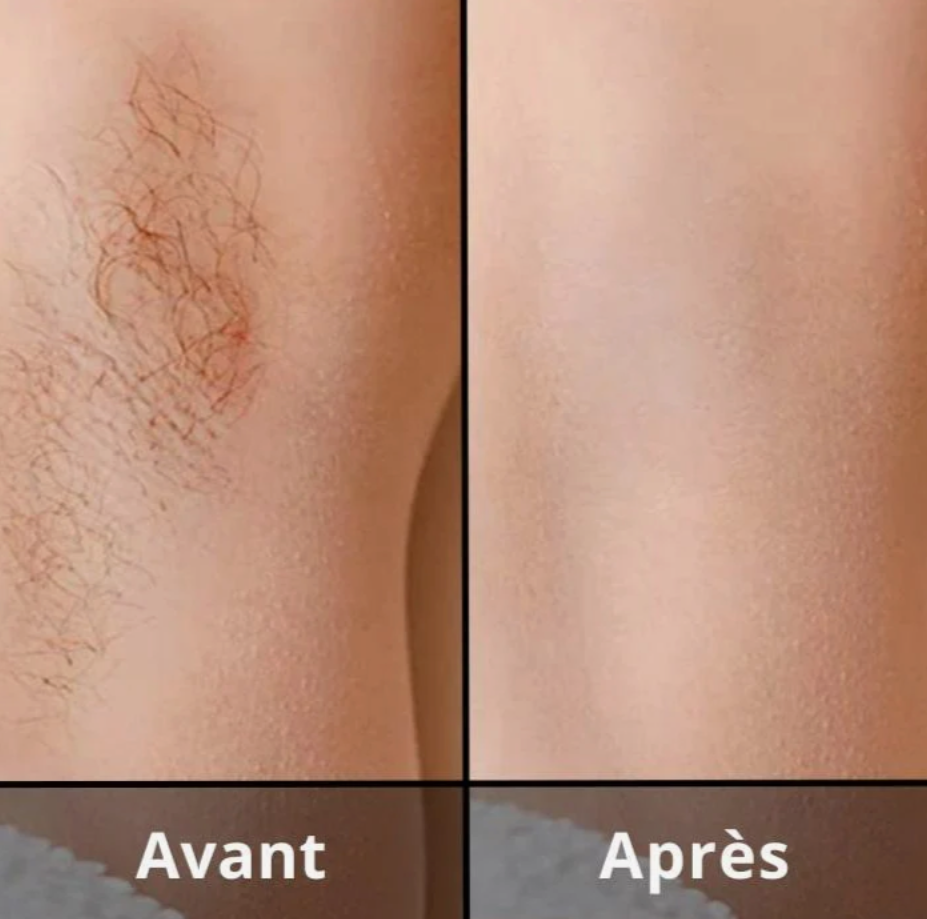 ÉPILATEUR IPL