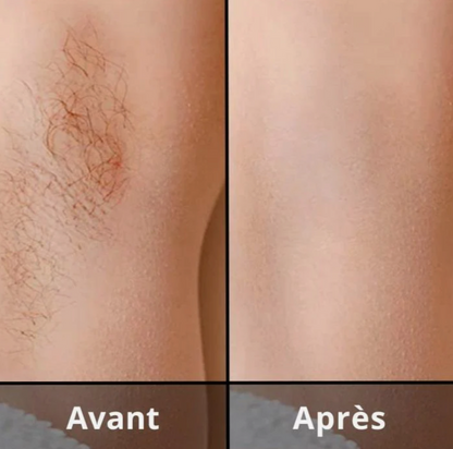 ÉPILATEUR IPL